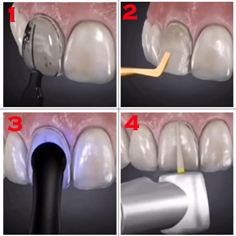 32Pcs Teeth Whitening Mould De - đánh giá và giá Teeth Whitening Moulds